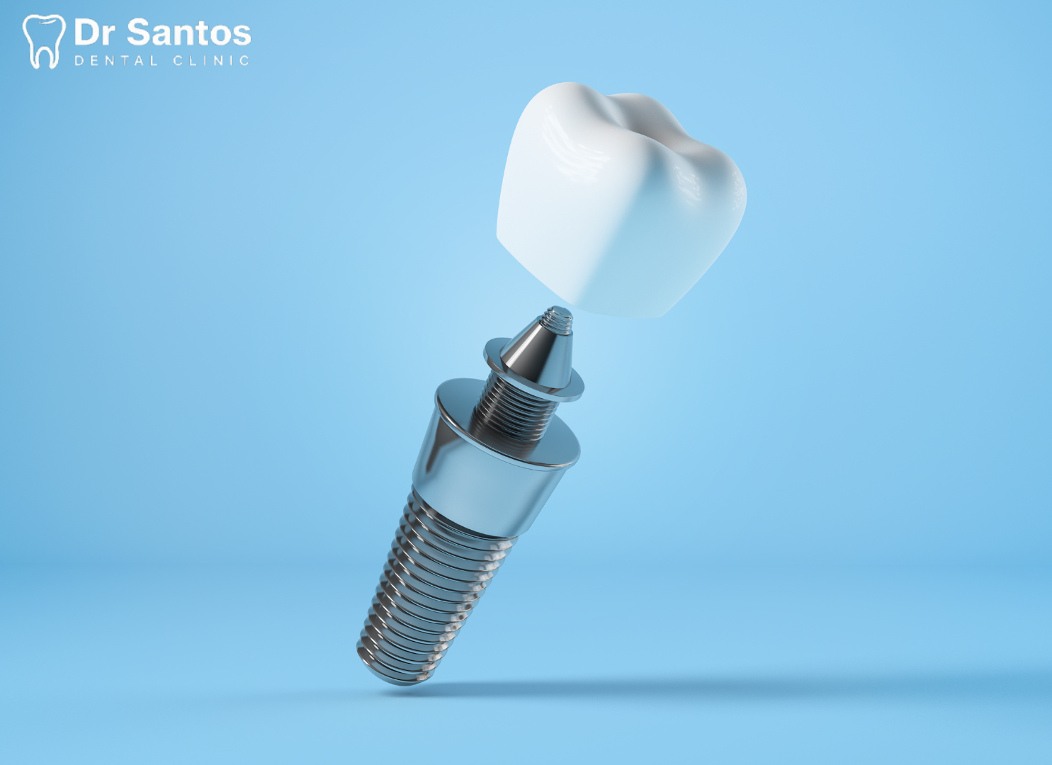 Diagrama de un implante dental mostrando el tornillo, el pilar y la corona.