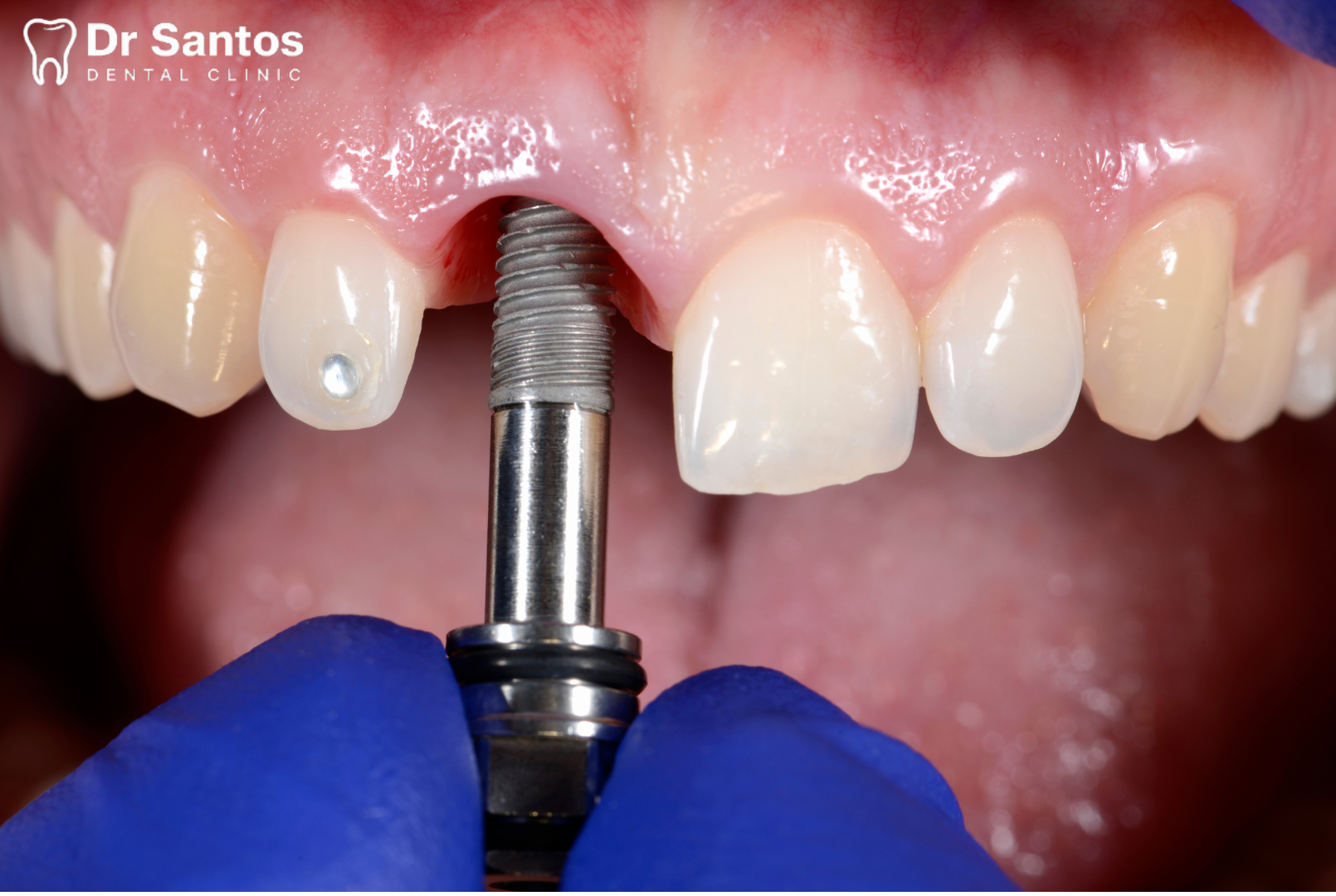 Ilustración de cómo un implante dental se integra en el hueso de la mandíbula.