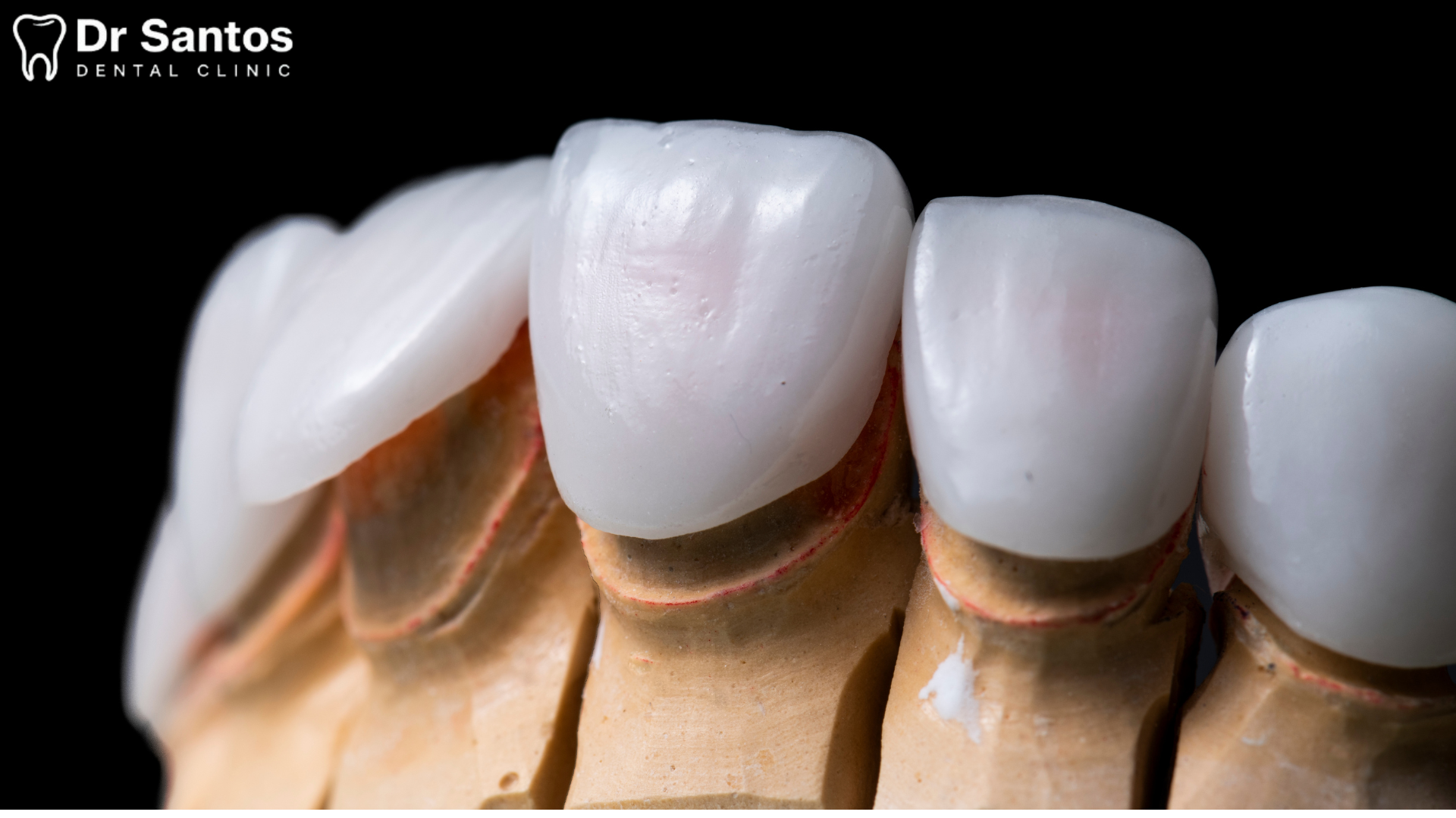 Ilustración de una carilla dental colocándose sobre un diente
