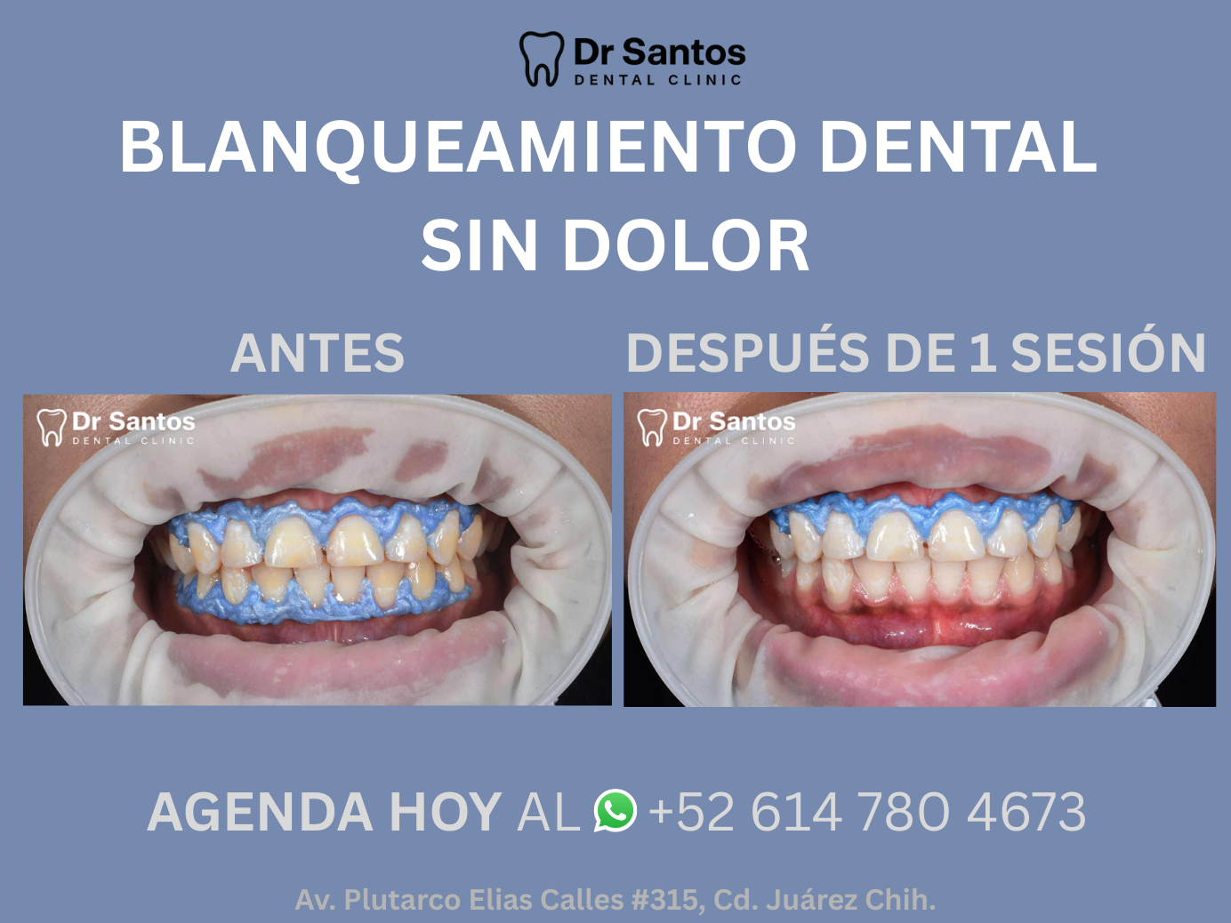 Paciente con una sonrisa blanca y radiante después de un blanqueamiento dental.